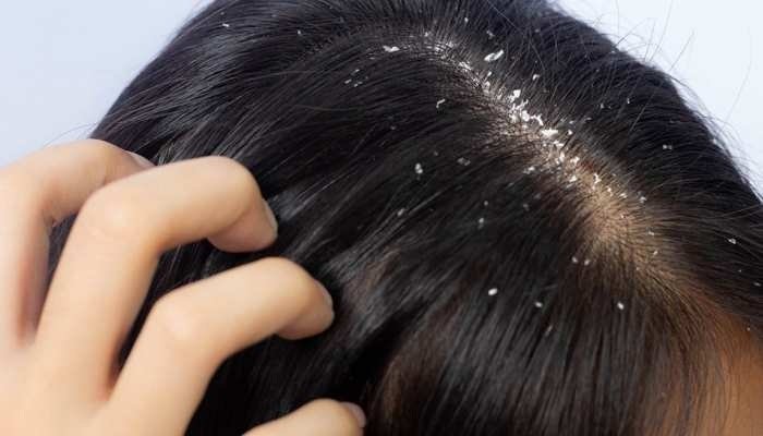 Dandruff Treatment Guide Causes Symptoms and Effective Solutions